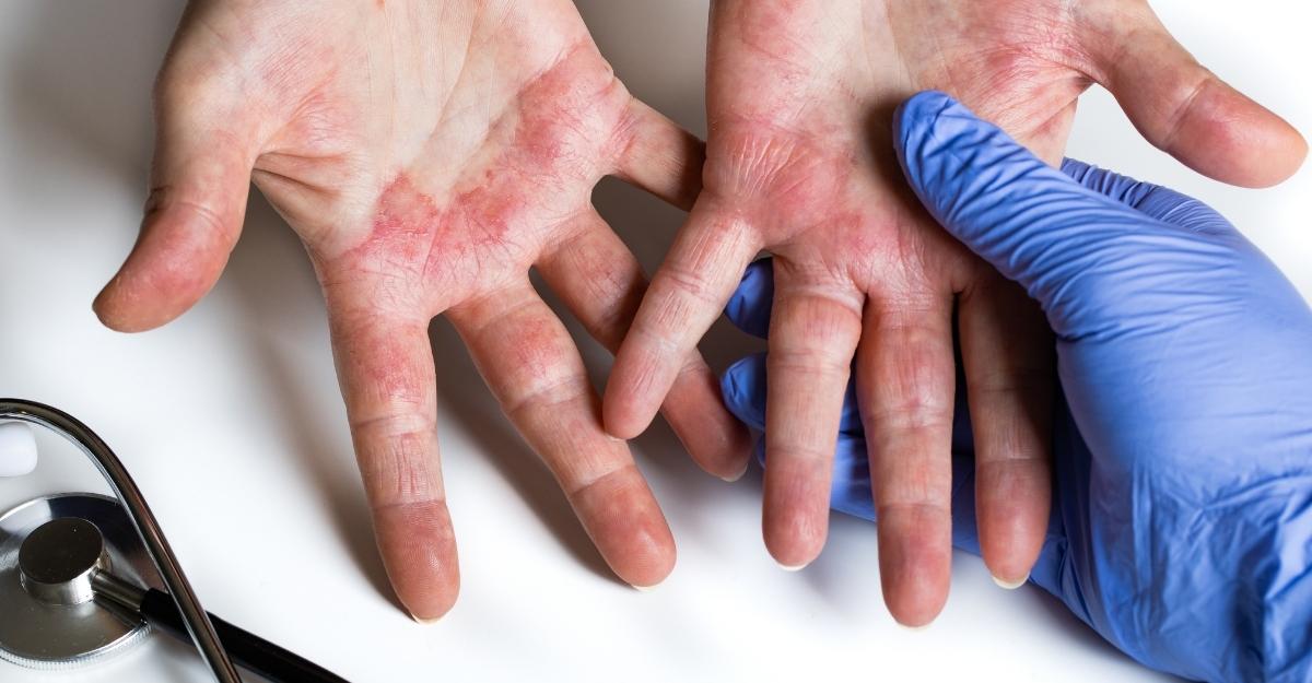 Dermatita de contact: Tipuri, cauze, simptome și tratament