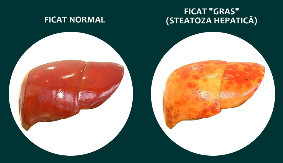 Steatoza hepatică sau ficatul gras - Tot ce e de știut