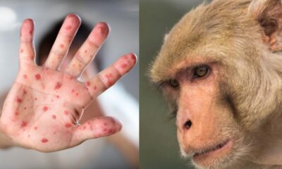 Variola maimuței: Simptome, mod de transmitere și tratament