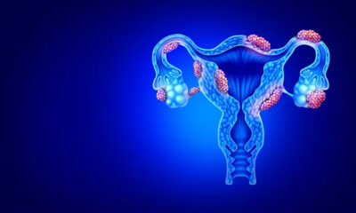 Alimentația și Endometrioza: Ce trebuie să știți despre dietă și inflamație