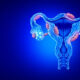 Alimentația și Endometrioza: Ce trebuie să știți despre dietă și inflamație